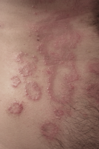Seborrheic Dermatitis All You Need To Know About This Type Of Eczema Dr John D Bray Md Blog