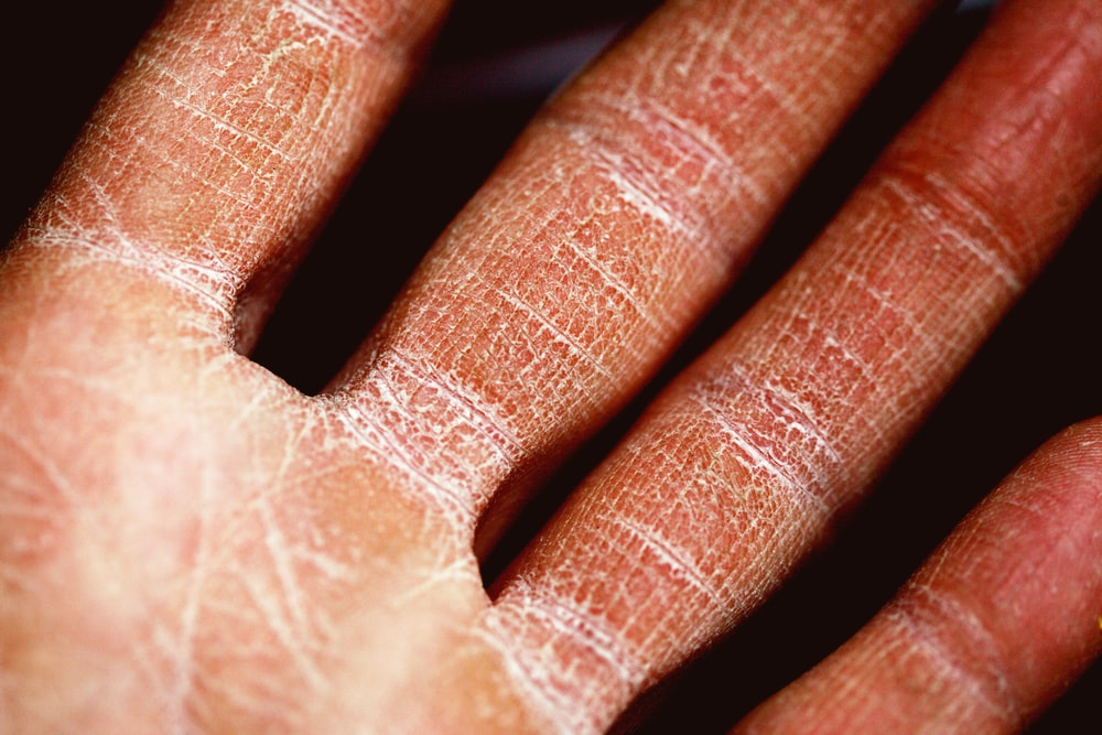 6 Common Triggers of Eczema Dr. John D. Bray, MD Blog