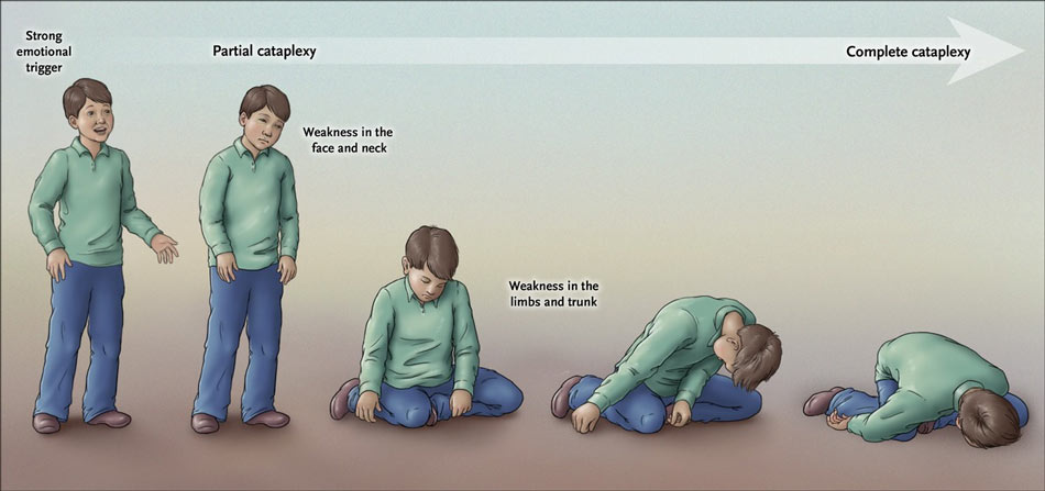 mild cataplexy