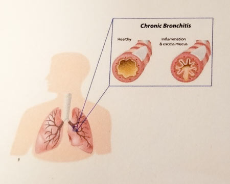 bronchitis